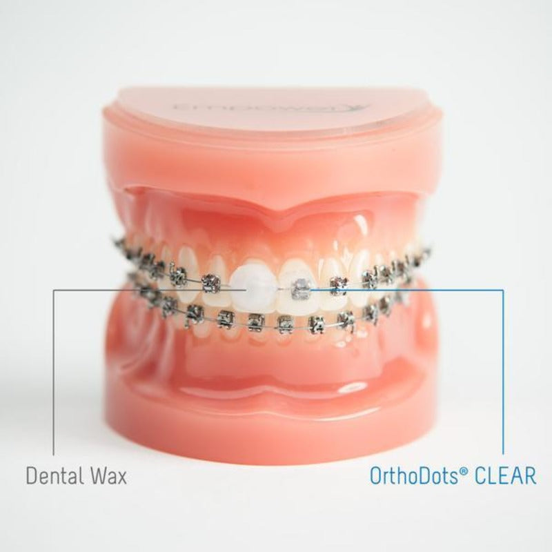 OrthoDots Dental Wax for Braces (1 best choice stays on longer